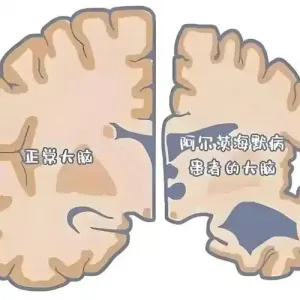 血管健康状况不佳会加速大脑衰老